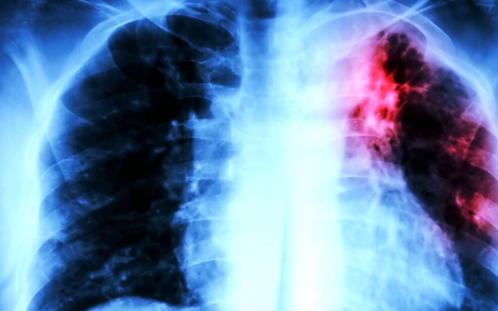 tuberculose